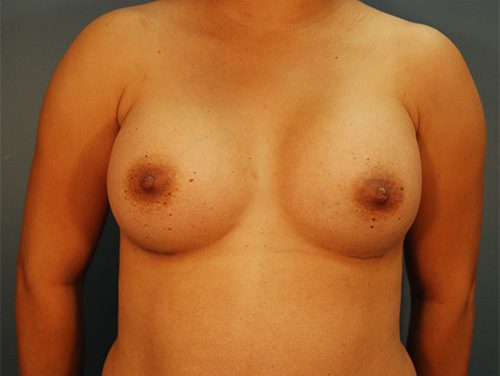 Case--5993 | After Breast Augmentation 