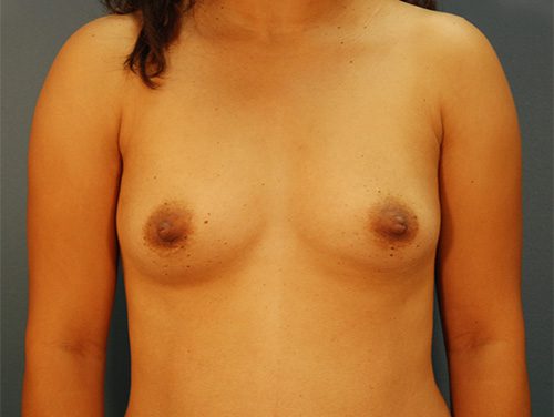 Case--5993 | Before Breast Augmentation 