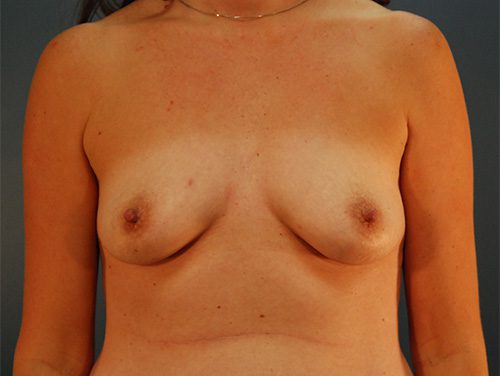 Case--3412 | Before Breast Augmentation 