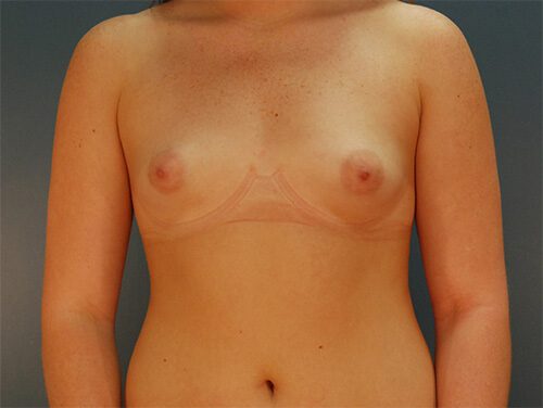 Case--4754 | Before Breast Augmentation 