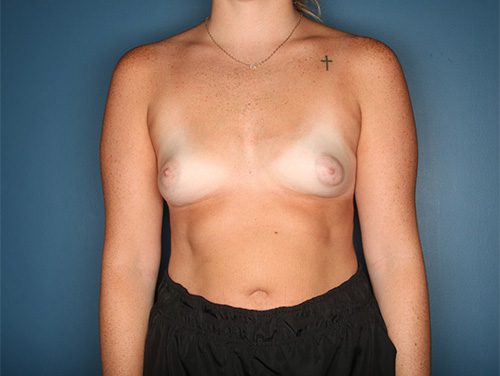 Case--6390 | Before Breast Augmentation 