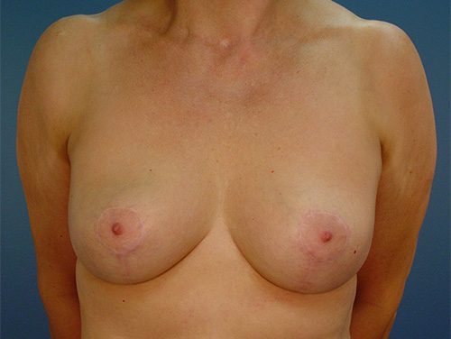 Case--9232 | After Breast 