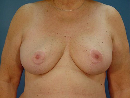 Case--4188 | After Breast 