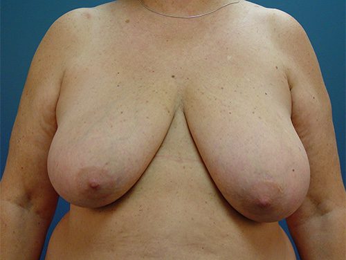 Case--4188 | Before Breast 