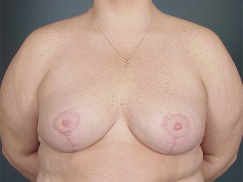Case--3781 | After Breast 