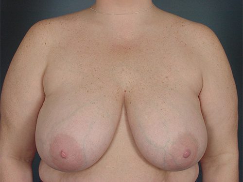 Case--3781 | Before Breast 