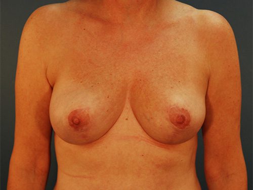 Case--5080 | After Breast 
