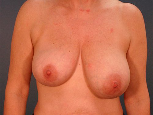 Case--5080 | Before Breast 