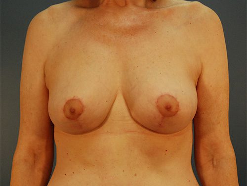 Case--9309 | After Breast 