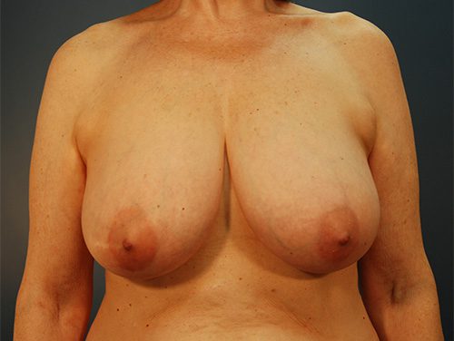 Case--9309 | Before Breast 