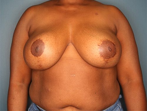 Case--5467 | After Breast 