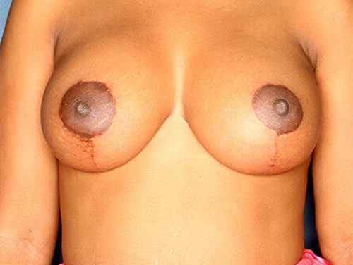 Case--7199 | After Breast 