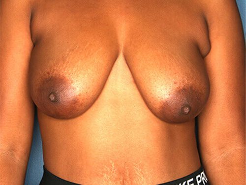Case--7199 | Before Breast 