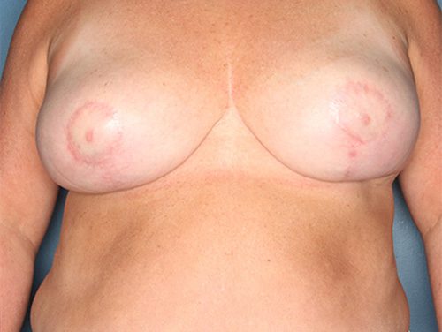 Case--2301 | After Breast 