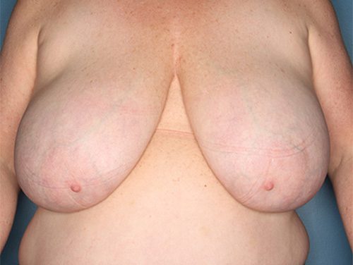 Case--2301 | Before Breast 
