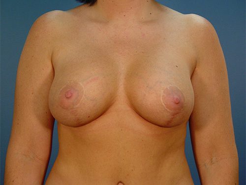 Case--6917 | After Breast 