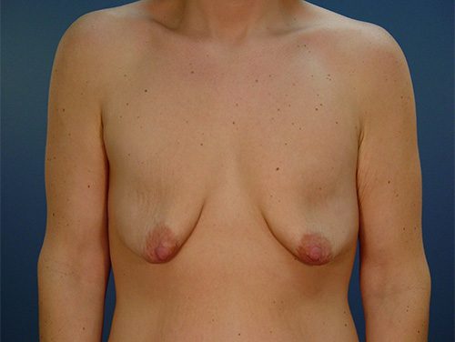 Case--4198 | Before Breast 