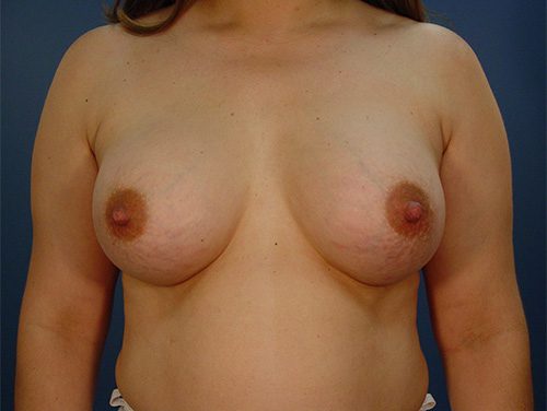 Case--1906 | After Breast 