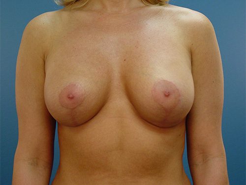 Case--7921 | After Breast 