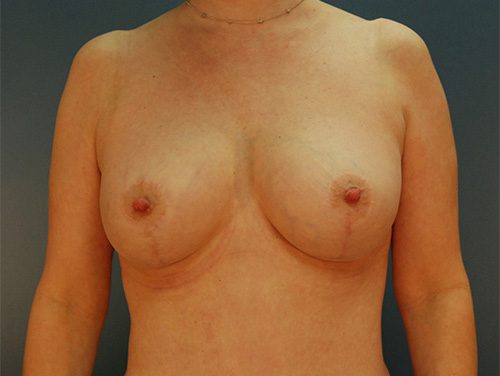 Case--2775 | After Breast 