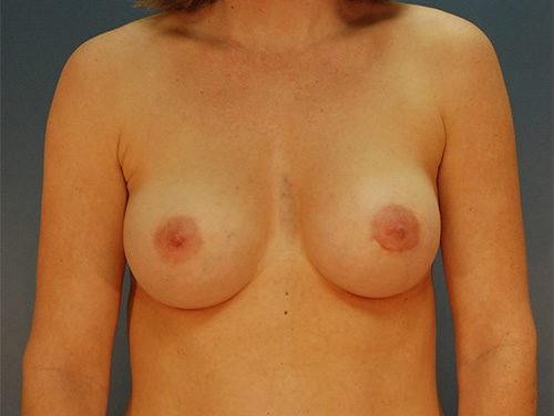 Case--959 | After Breast 