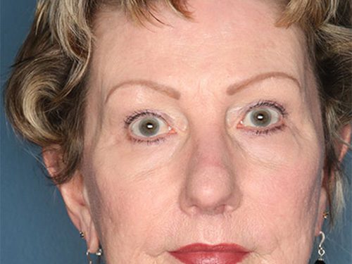 Case--709 | After Upper & Lower Eyelid Surgery 