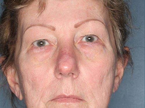 Case--709 | Before Upper & Lower Eyelid Surgery 