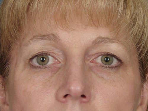 Brow Lift before