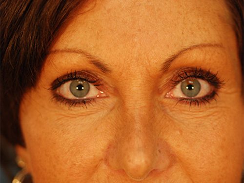 Case--9498 | After Upper & Lower Eyelid Surgery 