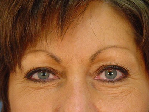 Case--9498 | Before Upper & Lower Eyelid Surgery 