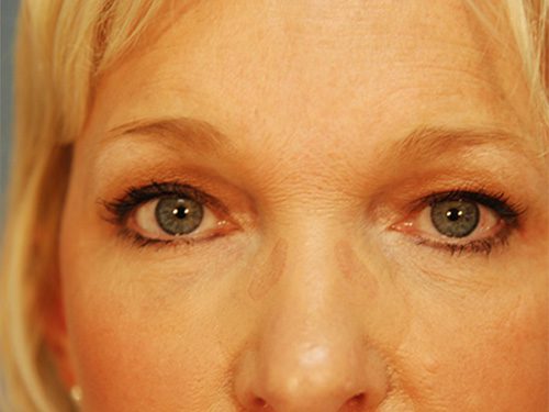 Case--1078 | After Upper & Lower Eyelid Surgery 