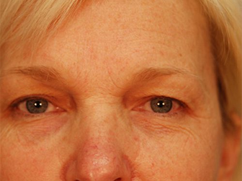 Case--1078 | Before Upper & Lower Eyelid Surgery 