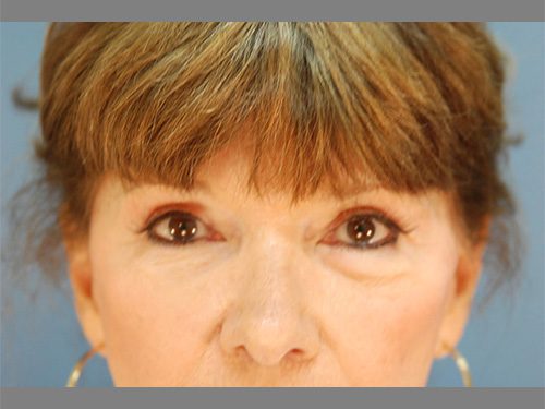 Case--7848 | After Upper & Lower Eyelid Surgery 