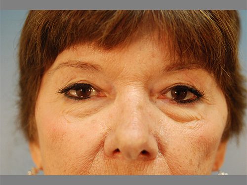 Case--7848 | Before Upper & Lower Eyelid Surgery 