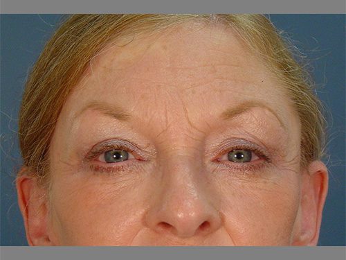 Case--1874 | After Upper & Lower Eyelid Surgery 
