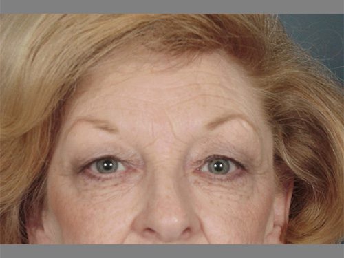 Case--1874 | Before Upper & Lower Eyelid Surgery 