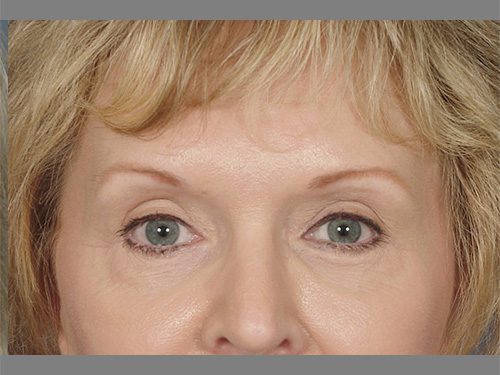 Case--622 | After Upper & Lower Eyelid Surgery 
