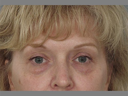 Case--622 | Before Upper & Lower Eyelid Surgery 