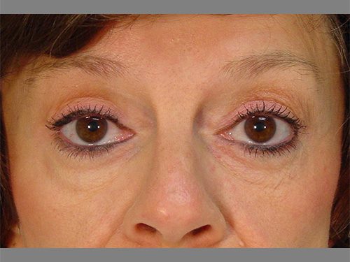 Case--994 | After Upper & Lower Eyelid Surgery 