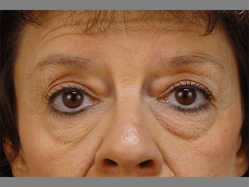 Case--994 | Before Upper & Lower Eyelid Surgery 
