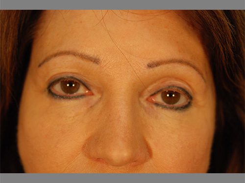 Case--4445 | After Upper & Lower Eyelid Surgery 