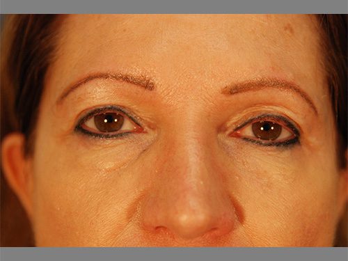 Case--4445 | Before Upper & Lower Eyelid Surgery 