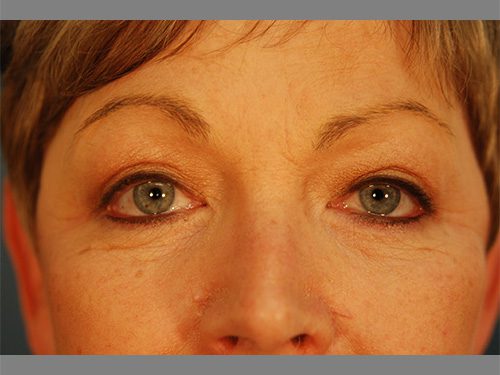 Case--3010 | After Upper & Lower Eyelid Surgery 