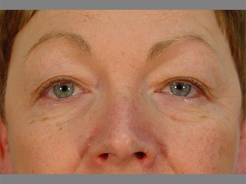 Case--3010 | Before Upper & Lower Eyelid Surgery 