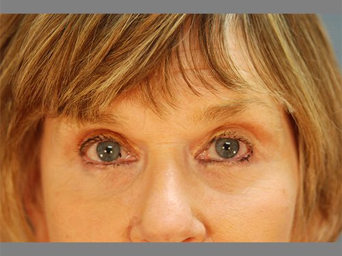 Case--6508 | After Upper & Lower Eyelid Surgery 