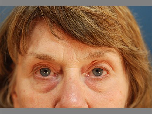 Case--6508 | Before Upper & Lower Eyelid Surgery 