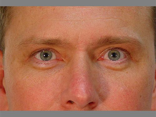 Case--8670 | After Upper & Lower Eyelid Surgery 