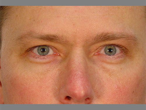 Case--8670 | Before Upper & Lower Eyelid Surgery 