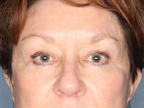 Case--8836 | After Upper & Lower Eyelid Surgery 