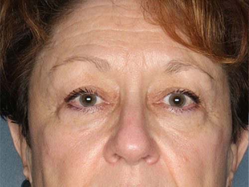 Case--8836 | Before Upper & Lower Eyelid Surgery 